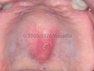 Clinical image of Traumatic oral ulcer - imageId=2500473. Click to open in gallery.  caption: 'A round crusted ulcer over a torus palatini.'