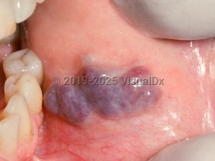 Clinical image of Oral hemangioma - imageId=2505948. Click to open in gallery.  caption: 'Confluent violaceous nodules on the buccal mucosa.'