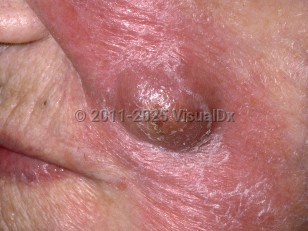 Clinical image of Actinomycosis - imageId=252777. Click to open in gallery.  caption: 'An erythematous plaque with overlying superficial scale and a central similar crusted nodule on the cheek.'