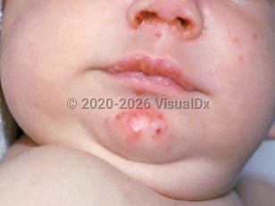 Clinical image of Congenital agammaglobulinemia - imageId=2530807. Click to open in gallery. 