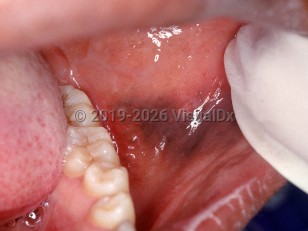 Clinical image of Multifocal or diffuse mucosal pigmentation - imageId=2556932. Click to open in gallery.  caption: 'A dark brown patch on the buccal mucosa.'