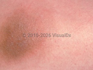 Clinical image of Vitamin K injection site reaction - imageId=2574632. Click to open in gallery.  caption: 'A close-up of a pink and light brown plaque with overlying tiny papules, 2 months after a vitamin K injection.'