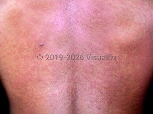 Human immunodeficiency virus primary infection