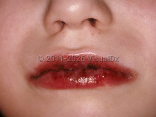 Kawasaki disease