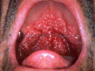 Mucocutaneous leishmaniasis