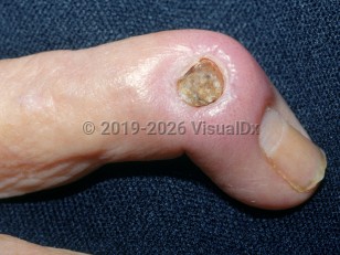 Osteomyelitis