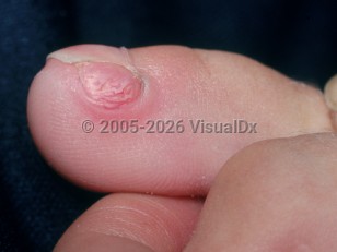 Clinical image of Subungual exostosis - imageId=2704448. Click to open in gallery.  caption: 'A pink papule on the nailbed with resultant paronychia.'