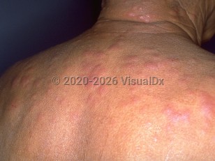 Clinical image of Type 1 lepra reaction - imageId=271424. Click to open in gallery.  caption: 'Numerous edematous pink papules and plaques on the posterior neck and back.'