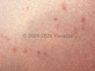 Clinical image of Enteric fever - imageId=2721479. Click to open in gallery.  caption: 'A close-up of tiny erythematous macules and thin papules ("rose spots").'