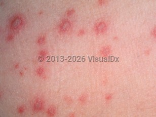 Clinical image of Neonatal varicella - imageId=2724932. Click to open in gallery.  caption: 'A close-up of vesicles on erythematous bases.'