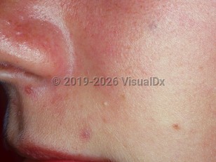 Naso-orbital-ethmoid fracture