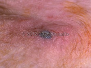 Clinical image of Bacterial sepsis - imageId=276067. Click to open in gallery.  caption: 'A close-up of a hemorrhagic vesicle and surrounding pink erythema.'