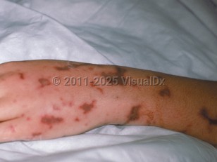 Clinical image of Purpura fulminans - imageId=277439. Click to open in gallery.  caption: 'Retiform, purpuric, and necrotic papules and plaques on the arm and hand.'