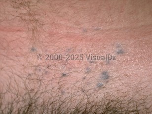 Clinical image of Glomangiomas - imageId=278270. Click to open in gallery.  caption: 'Multiple deep blue-gray macules and papules on the lower abdomen.'