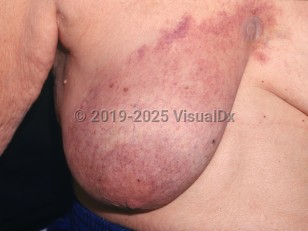 Clinical image of Cutaneous presentations of breast cancer - imageId=2803850. Click to open in gallery. 