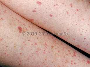 Clinical image of Immune thrombocytopenic purpura - imageId=2835942. Click to open in gallery.  caption: 'Many petechial macules and patches on the legs.'