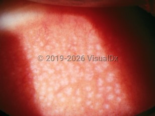 Ophthalmic Imaging image of Giant papillary conjunctivitis - imageId=2893823. Click to open in gallery.  caption: 'Myriad faint pink-white papules (papillae) on the pretarsal conjunctiva of the upper eyelid.'