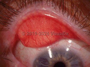 Floppy eyelid syndrome