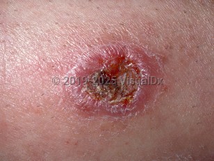 Clinical image of Cutaneous leishmaniasis - imageId=290962. Click to open in gallery.  caption: 'Close-up of a dull pink, scaly plaque with a central crusted ulcer.'