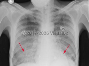 Imaging Studies image of Pneumocystis jirovecii pneumonia - imageId=2956223. Click to open in gallery.  caption: 'Frontal chest x-ray with diffuse, bilateral ground glass opacities with progression to air space consolidation, worse in the lower lobes.'