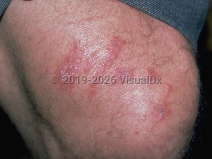 Clinical image of Coral injury - imageId=295689. Click to open in gallery.  caption: 'Linear and patterned edematous and erythematous papules and plaques on the knee from coral.'