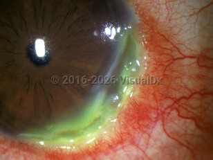 Ophthalmic Imaging image of Marginal keratitis - imageId=2977593. Click to open in gallery. 