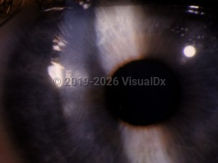 Ophthalmic Imaging image of Lyme keratitis - imageId=2986751. Click to open in gallery. 