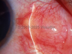 Ophthalmic Imaging image of Nodular episcleritis - imageId=2994396. Click to open in gallery. 