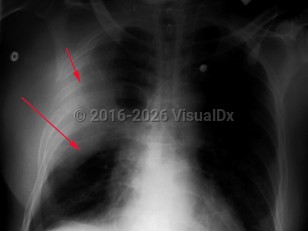 Imaging Studies image of Klebsiella pneumonia - imageId=3010271. Click to open in gallery.  caption: 'Frontal chest xray with homogeneous parenchymal consolidation of the right upper lobe, (short arrow).&nbsp; There is downward displacement of the fissure related to lobar expansion, (long arrow),&nbsp;as seen with Klebsiella pneumonia.'