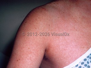 Measles