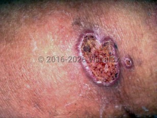 Clinical image of Paracoccidioidomycosis - imageId=3068034. Click to open in gallery.  caption: 'A close-up of an ulcerated and crusted papule and a similar plaque, both with raised, rolled, pink and violaceous borders.'