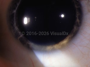 Ophthalmic Imaging image of Wilson disease - imageId=3083243. Click to open in gallery. 