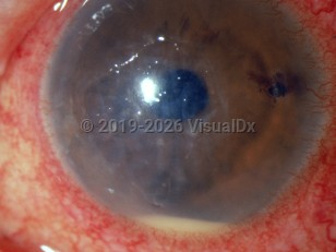 Ophthalmic Imaging image of Bacterial corneal ulcer - imageId=3104703. Click to open in gallery. 
