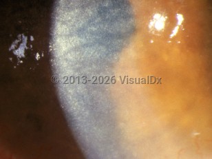 Ophthalmic Imaging image of Cystinosis - imageId=3105948. Click to open in gallery. 