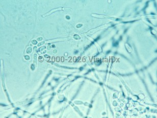 Lab image of Vulvovaginal candidiasis - imageId=311552. Click to open in gallery.  caption: 'A high-power view of yeasts and pseudohyphae.'