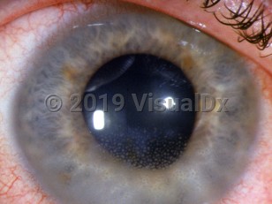 Ophthalmic Imaging image of Uveitis - imageId=3140168. Click to open in gallery. 