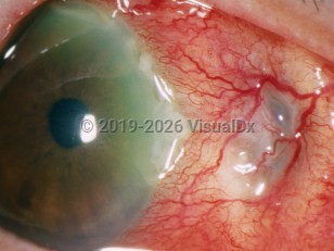 Ophthalmic Imaging image of Necrotizing scleritis - imageId=3158975. Click to open in gallery. 