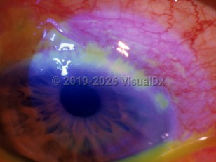 Ophthalmic Imaging image of Herpes simplex virus conjunctivitis - imageId=3175118. Click to open in gallery. 