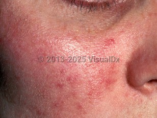 Clinical image of Rosacea - imageId=331974. Click to open in gallery.  caption: 'Erythema, telangiectasias, and few scattered inflammatory papules on the cheek.'