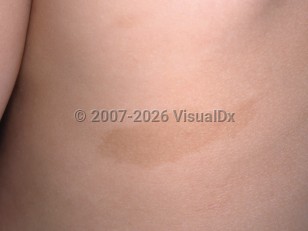 Clinical image of Café au lait spot - imageId=3341470. Click to open in gallery.  caption: 'A close-up of a well-demarcated, oval, light brown patch on the back.'