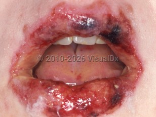 Stevens-Johnson syndrome