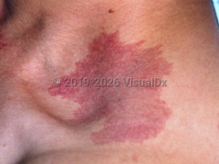 Clinical image of Port-wine birthmark - imageId=3351600. Click to open in gallery.  caption: 'A violaceous patch at the supraclavicular fossa.'