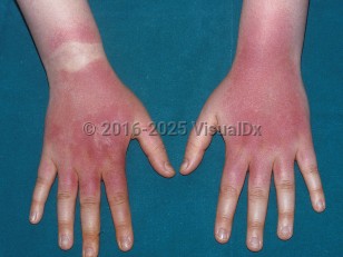 Clinical image of Drug-induced phototoxic reaction - imageId=337847. Click to open in gallery.  caption: 'Deep red patches and plaques on the dorsal wrists, hands, and fingers, sparing the area under the wristwatch, secondary to a medication.'