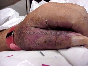 Nephrogenic systemic fibrosis