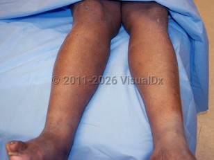 Deep vein thrombosis