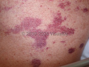 Strongyloidiasis