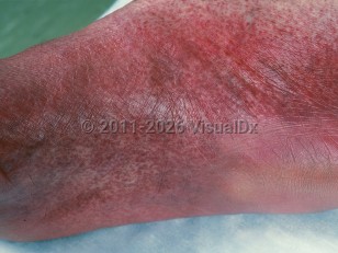 Drug-induced non-palpable purpura