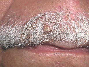 Clinical image of Trichilemmoma - imageId=3922332. Click to open in gallery.  caption: 'An elongated pink papule with a distal keratotic surface on the upper cutaneous lip.'