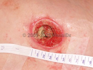 Clinical image of Pressure injury - imageId=3969344. Click to open in gallery.  caption: 'A close-up of a stage 4 pressure injury showing a deep crateriform ulcer with overlying slough.'