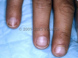 Clinical image of Terry nails - imageId=4037481. Click to open in gallery.  caption: 'Pallor of the fingernails, sparing the distal 2mm where a brown band is seen.'